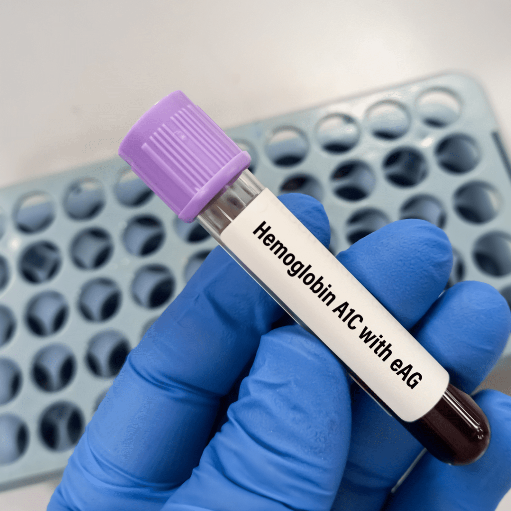 "Blood test vial labeled for hemoglobin level measurement, indicating red blood cell protein check for anemia and oxygen transport efficiency."