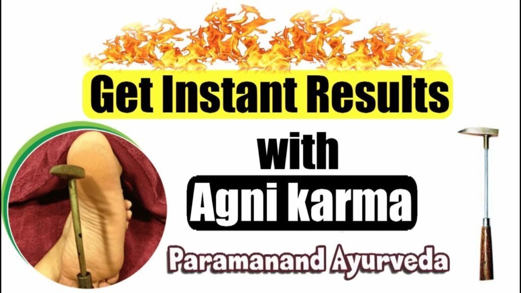 Agni Karma is a traditional treatment in Ayurveda that uses heat to reduce pain and swelling in the body. It’s especially helpful for joint problems, like arthritis, where the joints are stiff, swollen, or painful