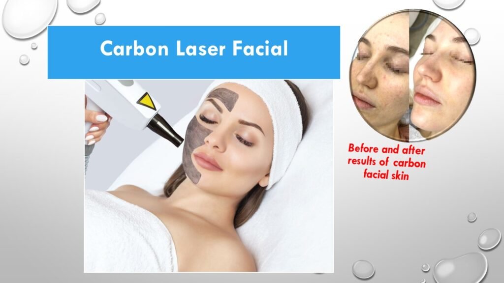 "Before and after results of a carbon laser facial showing clearer, glowing skin with reduced pores and improved texture in just 30 minutes."