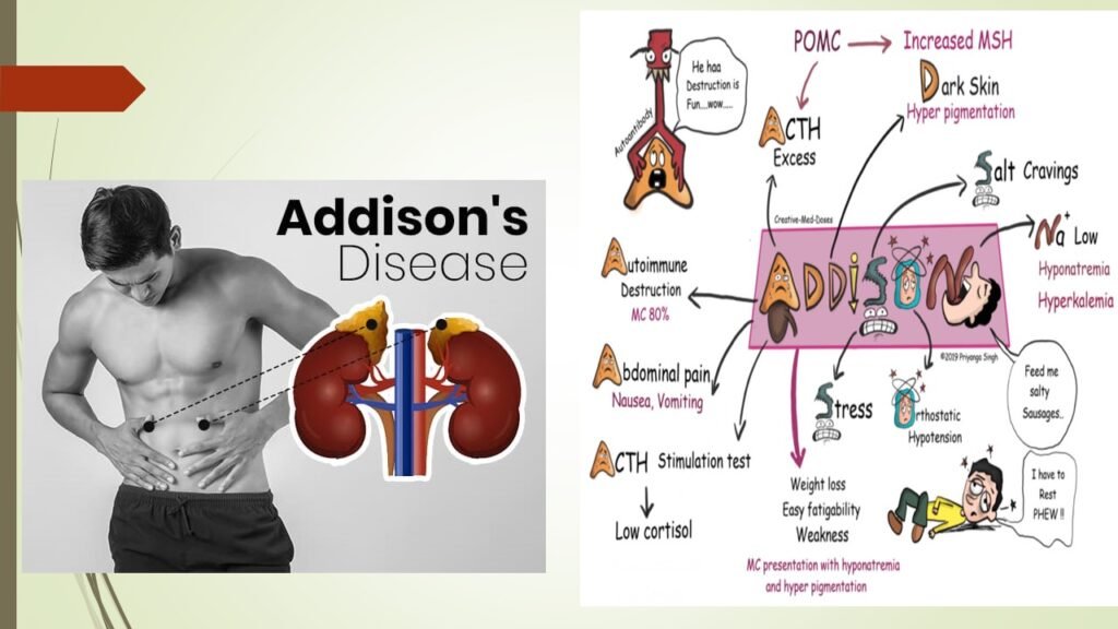 Illustration of Addison's Disease showing the adrenal glands and their role in hormone production, highlighting symptoms like fatigue, weight loss, and skin changes