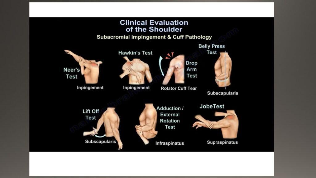 Detailed shoulder pain diagnosis chart illustrating common pain areas and associated conditions like rotator cuff injuries, shoulder impingement, arthritis, and tendonitis