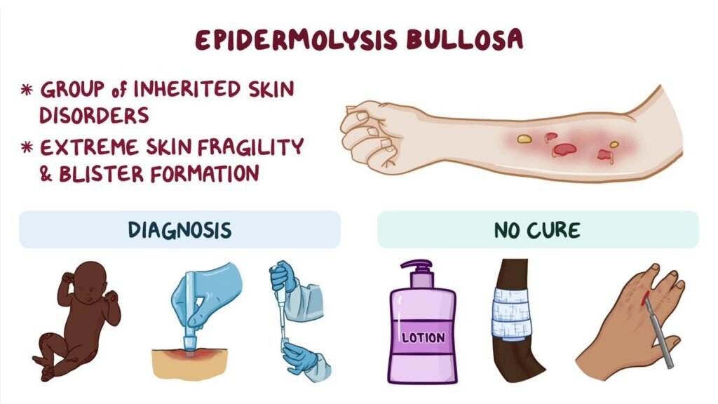 "Close-up of a child’s hand with epidermolysis bullosa, showing delicate, blistered skin covered with protective bandages. The image illustrates the fragility of the skin affected by EB and highlights the careful wound care needed for this rare genetic condition."