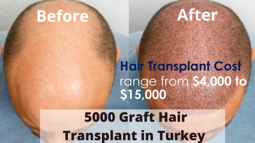 "Close-up of a person's head before and after a hair transplant, showing significant improvement in hair density and fullness."